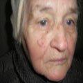 3. Меланома 