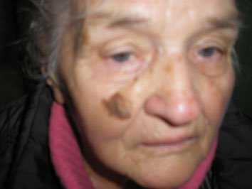 3. Меланома 
