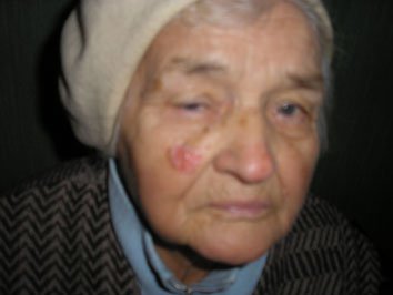 3. Меланома 
