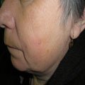 3. Шкірний ріг 