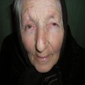 7. Базально-клітинний рак шкіри (вузлувата форма)