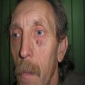 6. Базально-клітинний рак шкіри (базаліома) вузлувата форма