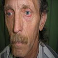 6. Базально-клітинний рак шкіри (базаліома) вузлувата форма