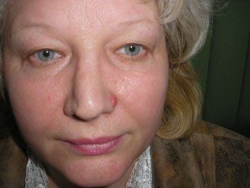 2. Базально-клітинний рак шкіри (базаліома) вузлувата форма