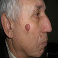 4. Базально-клітинний рак шкіри (базаліома) вузлувата форма