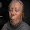 4. Базально-клітинний рак шкіри (базаліома) вузлувата форма