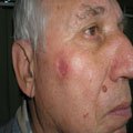 4. Базально-клітинний рак шкіри (базаліома) вузлувата форма