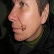 2. Базально-клітинний рак шкіри (базаліома) вузлувата форма (внизу дерматофіброми)