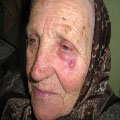 3. Базально-клітинний рак шкіри (базаліома) вузлувата форма