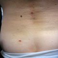 2. Меланома (вузлувата форма) та складні внутрішньодермальні невуси 