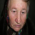 8. Базально-клітинний рак шкіри (базаліома) вузлувата форма