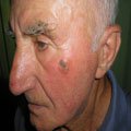 1. Меланома поверхнево-розповсюджена 