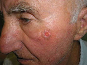 1. Меланома поверхнево-розповсюджена 