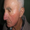 1. Меланома поверхнево-розповсюджена 