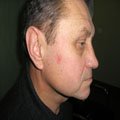 3. Меланома (вузлувата форма) 