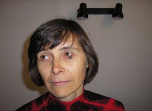 8. Базаліома