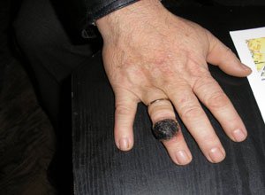 3. Унікальний випадок меланоми на пальці