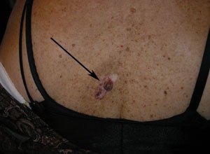 3. Базаліома