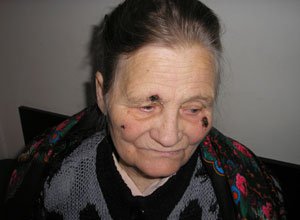 2. Гігантський базально-клітинний рак шкіри