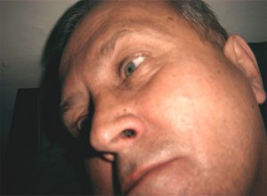 2. Папілома в носі