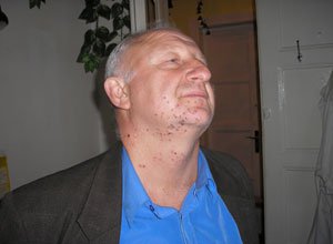 3. Множинні бородавки