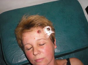 2. Базаліома