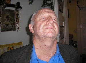 3. Множинні бородавки