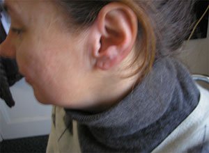 7. Невус