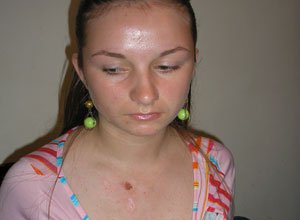 2. Невус