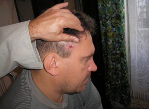 1. Базаліома
