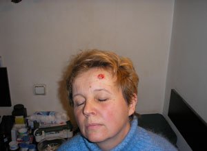 2. Базаліома