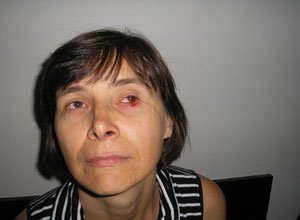 8. Базаліома