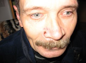 6. Папілома на носі