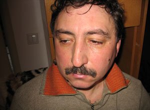 8. Дематофіброма на обличчі