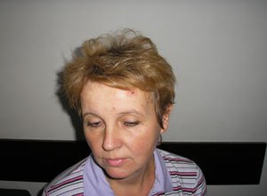 2. Базаліома