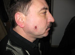 8. Дематофіброма на обличчі