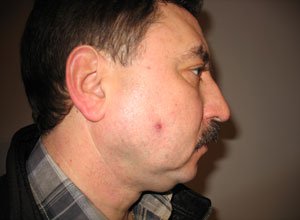 8. Дематофіброма на обличчі