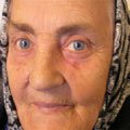 5. Гігантський базально-клітинний рак шкіри