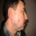 8. Дематофіброма на обличчі