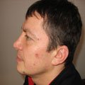 1. Дерматофіброма на обличчі