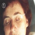 6. Набутий складний внутрідермальний невус