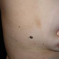 4. Невус