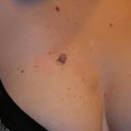 5. Невус
