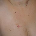 5. Невус